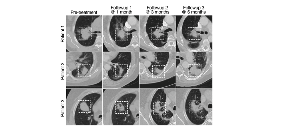 deep-learning-predicts-lung-cancer-treatment-response-from-serial-medical-imaging-1